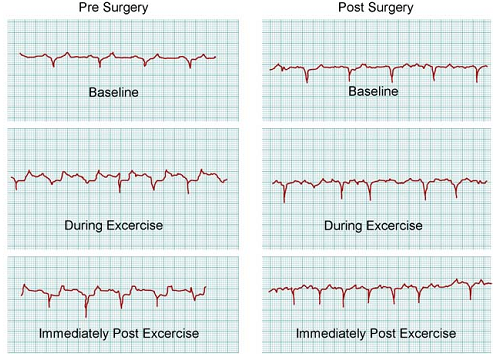 654_Stress Testing after Myocardial Infraction.png